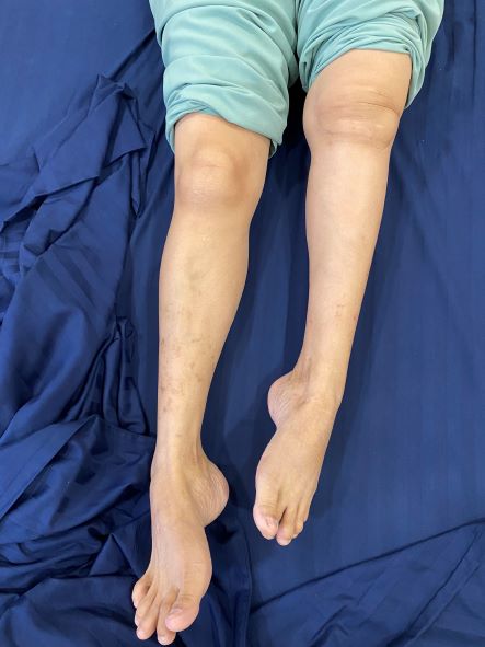 (Hình ảnh bệnh nhân trước khi mổ) Chân trái ngắn hơn chân phải khoảng 10cm, bệnh nhân không thể đi lại bằng chân trái
