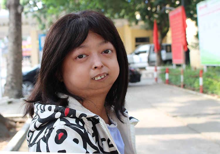 Nguyễn Mai Lan là con thứ hai trong gia đình có 3 người con, chỉ mình cô có vẻ ngoài khác biệt, do trận sốt nặng năm một tuổi. Ảnh: Phạm Nga.